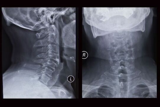 Hình ảnh X quang cột sống cổ (bệnh nhân bị hoại tử xương)