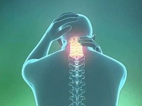 Một triệu chứng của bệnh hoại tử xương cổ tử cung là đau đầu