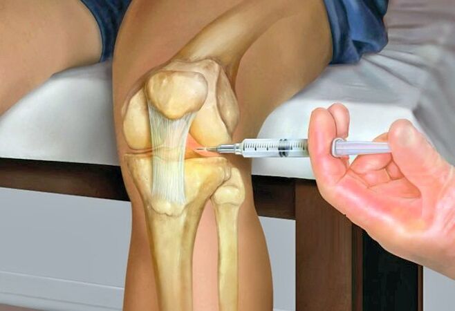 Điều trị khớp đầu gối