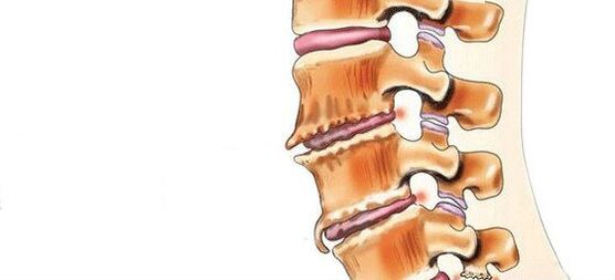 Bệnh cột sống - phá hủy khớp intervertebral