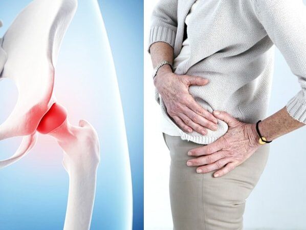 Các triệu chứng của bệnh viêm khớp hông