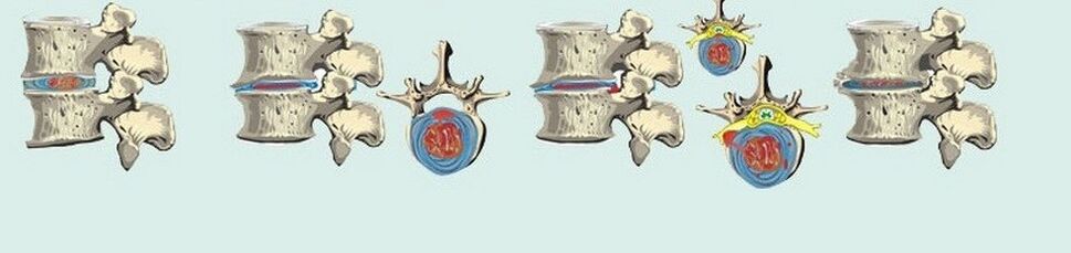 các giai đoạn khác nhau của thoái hóa xương sụn ngực