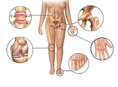 bệnh viêm khớp ảnh hưởng đến các khớp khác nhau