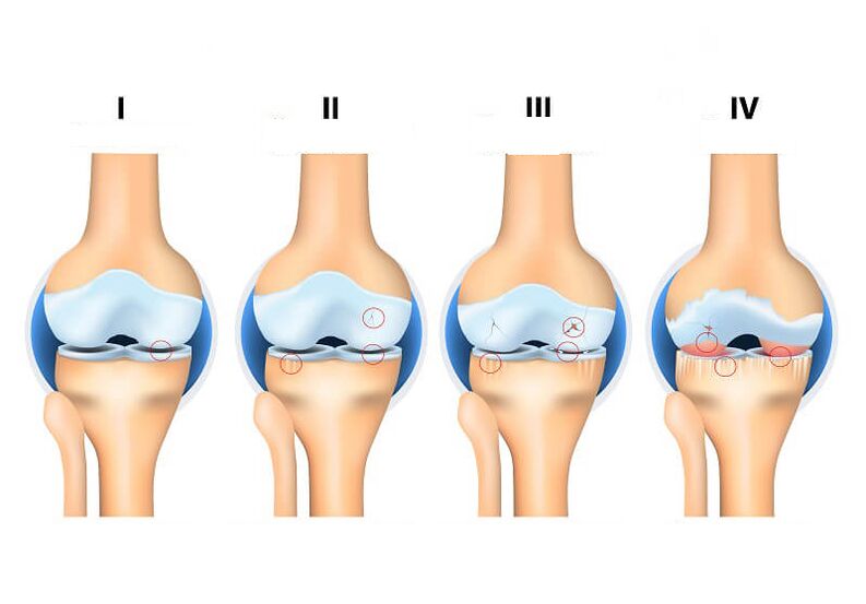 các giai đoạn của bệnh viêm khớp