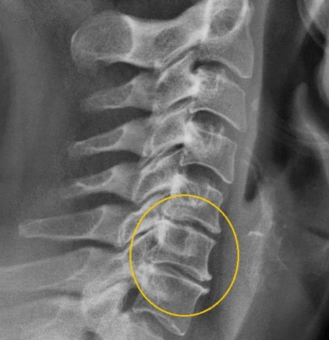 thoái hóa đốt sống cổ