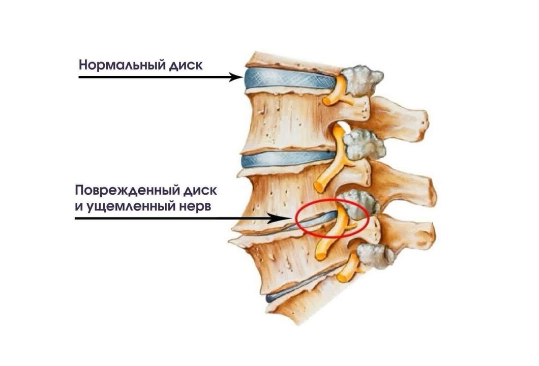 Các triệu chứng của thoái hóa đốt sống cổ
