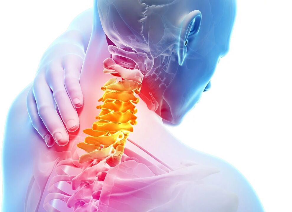 Thoái hóa xương cổ